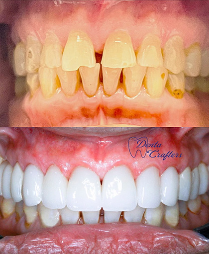 Close up of smile before and after cosmetic dentistry work