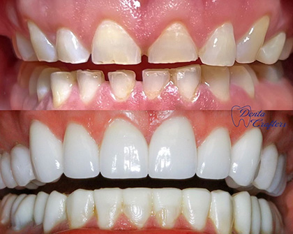 Close up of smile before and after fixing slightly gapped and short teeth