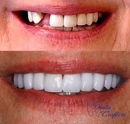 Close up of smile before and after replacing a missing upper tooth