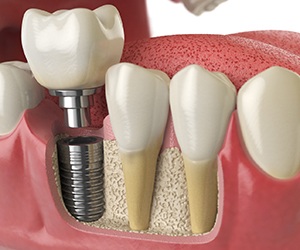 A 3D illustration of a single-tooth dental implant