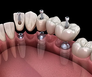 A 3D illustration of an implant bridge