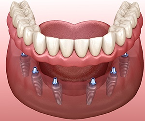 A 3D illustration of an implant denture