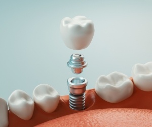Illustrated dental implant in the jaw with abutment and crown