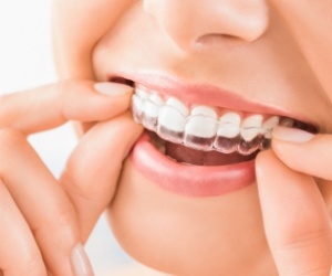 Close up of person placing Invisalign tray over their teeth