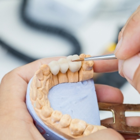 Dentist designing a dental bridge to replace missing teeth