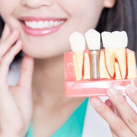 Dentist holding a model of the jaw with a dental implant