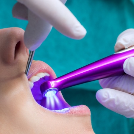 Close up of dentist shining light on teeth with dental sealants