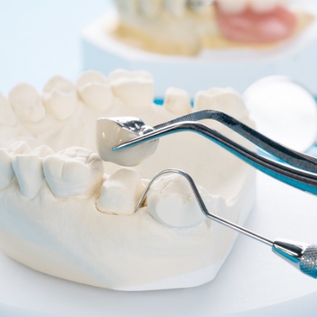 Dentist placing a dental crown on a tooth in model of the jaw