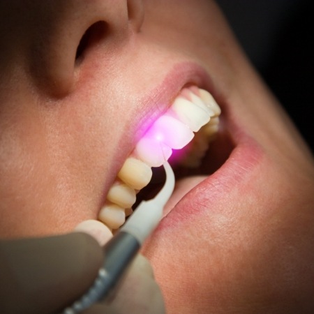 Close up of dental patient having their gums treated with a soft tissue laser