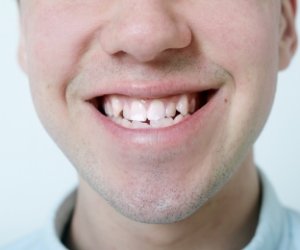 Close up of smile with misaligned teeth